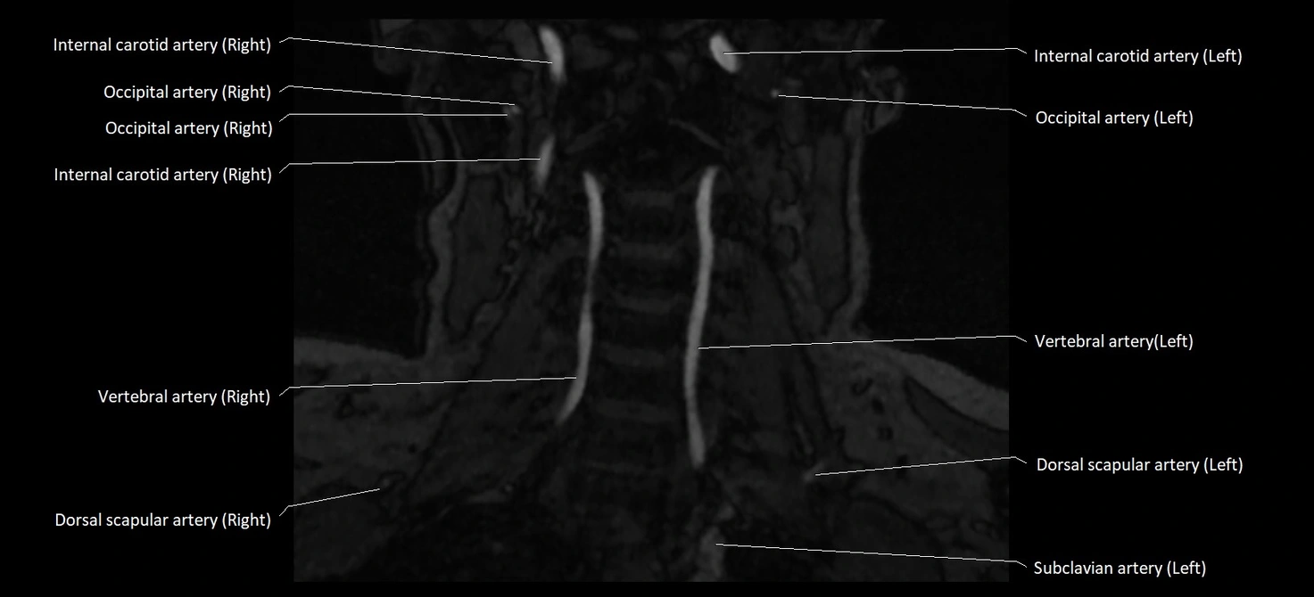 MRA carotid artery anatomy cross sectional 3T coronal image 10.webp